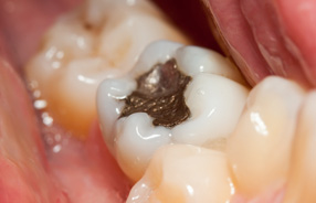 Dental amalgam fillings in Northridge and San Fernando Valley