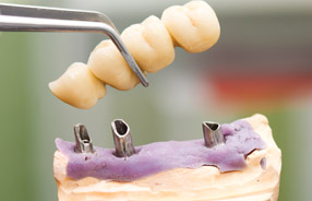 Dental bridges in Northridge and San Fernando Valley