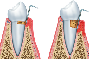 Dental periodontics in Northridge and San Fernando Valley